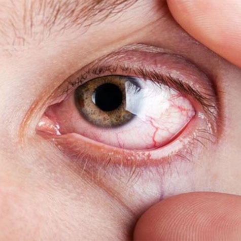 Sinsi hastalık Glokom “Göz Tansiyonu” nedir?