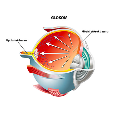 Göz Tansiyonu hakkında önemli hususlar.